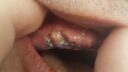 Nahaufnahme der Lippen und des Mundes einer Person. Die Oberlippe wird mit den Fingern nach hinten gezogen, sodass Zahnnähte, Schwellungen am Zahnfleisch nach einer oralen Operation und ein sichtbares Implantat sichtbar sind.