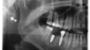Eine Röntgenaufnahme eines Unterkiefers zeigt Zahnimplantate und natürliche Zähne. Im Kieferknochen ist ein schraubenartiges Implantat sichtbar, das die Präzision moderner Zahnersatztechniken veranschaulicht. Das gesamte Bild ist in Graustufen dargestellt.