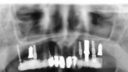 Röntgenbild eines Zahnscans, das mehrere Zahnimplantate und Zähne zeigt. Der Kieferknochen und die Nebenhöhlen sind ebenfalls sichtbar, wobei metallische Implantatschrauben im Ober- und Unterkiefer deutlich zu erkennen sind.