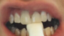 Eine Nahaufnahme des Mundes einer Person zeigt eine obere Zahnreihe mit einer Zahnfarbskala, die zur Farbabstimmung an die Vorderzähne gehalten wird. Diese wird oft bei Verfahren wie Zahnersatz oder Implantaten verwendet, um ein natürliches Aussehen zu gewährleisten.