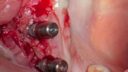 Nahaufnahme einer Zahnoperationsstelle, die mehrere im Zahnfleisch eingebettete Zahnimplantate zeigt, wobei das umgebende Gewebe rot und entzündet erscheint. Neben den Implantaten sind benachbarte natürliche Zähne sichtbar.