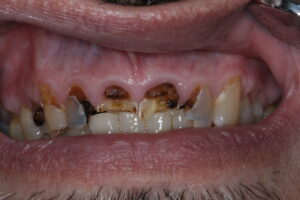 Mundtrockenheit, Xerostomie: durch Karies zerstörte Frontzähne