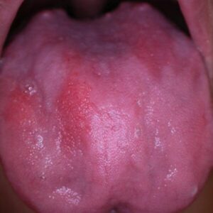 Glossitis Vitaminmangel Mangelernährnung Nährstoffmangel