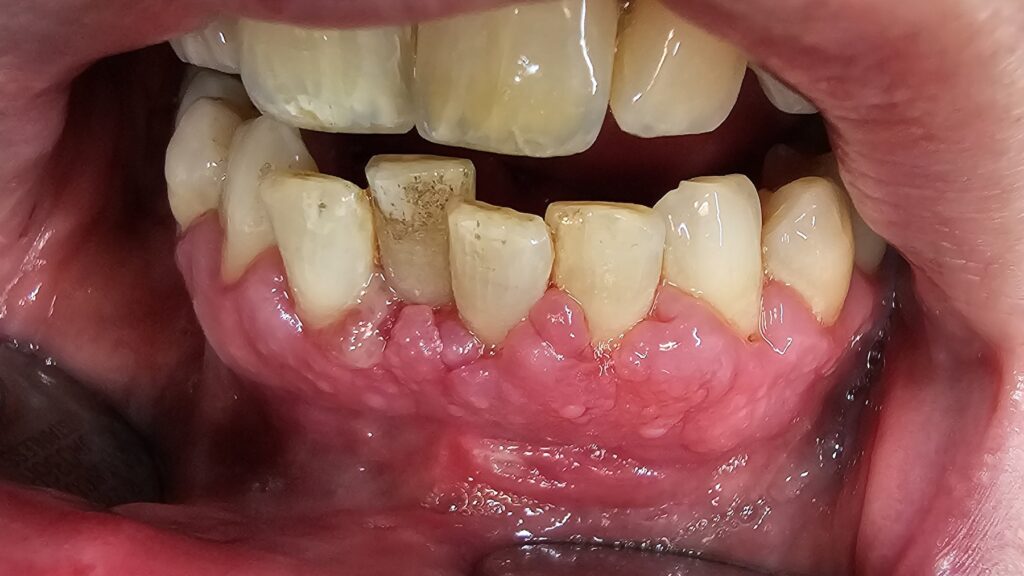 Gingivahyperplasie, Zahnfleischwucherung, Pseudotasche