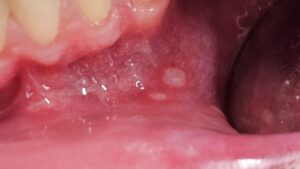 Aphten Aphten in der Umschlagfalte