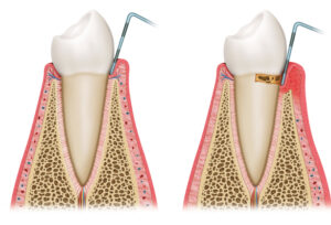 Parodontitis Stadien 1 und 2 Zahnfleischtaschen