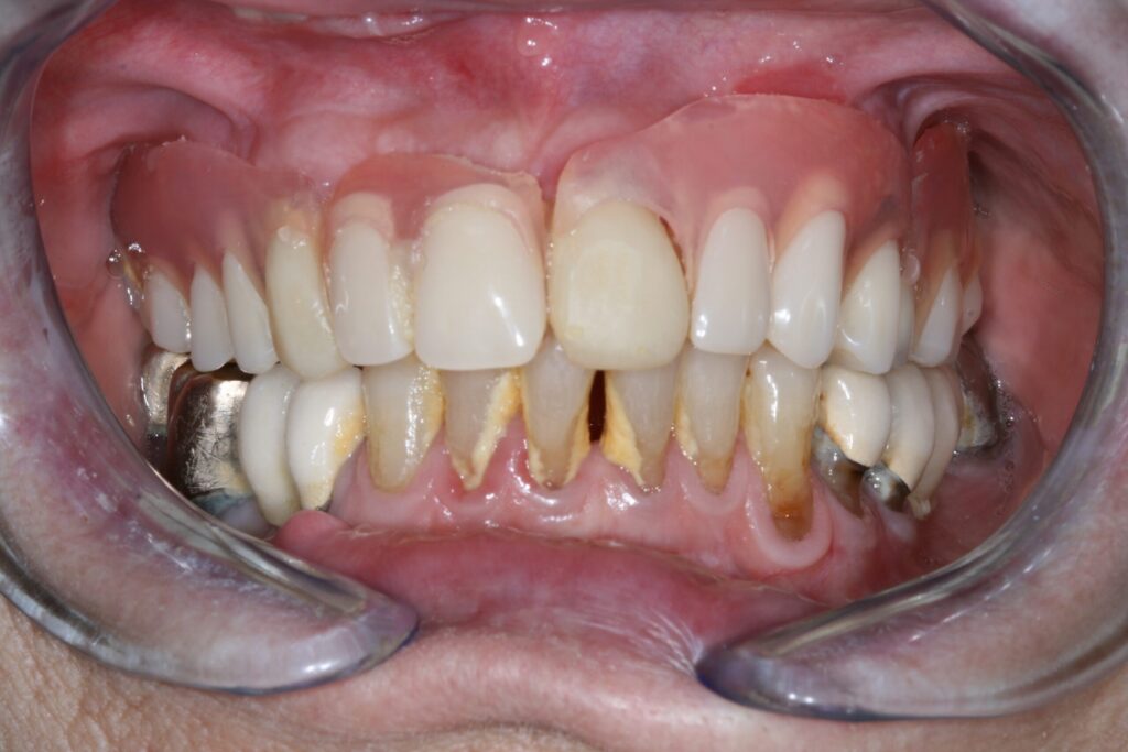 Parodontitis, Zahnfleischentzündung