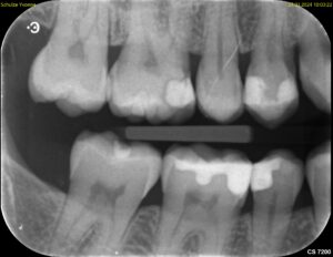 Röntgen Zahnfilm-Bissfluegelaufnahme