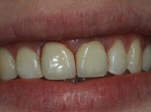 Entzündetes Zahnfleisch