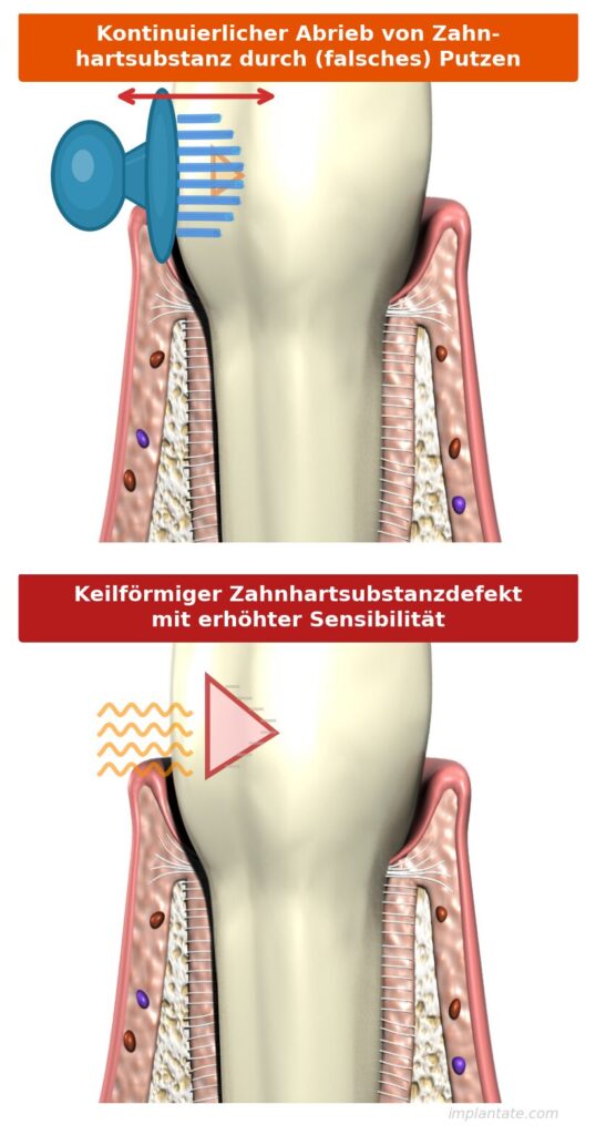 NCCL- Zahnhalsfdefekte, Putzdefekte, , überempfindliche Zahnhälse