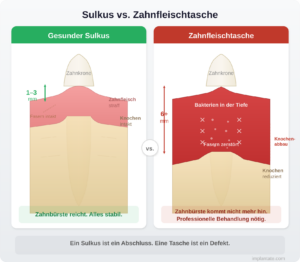 Zahnfleisch-Sulcus oder Zahnfleischtasche?