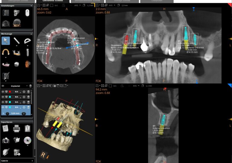 3D-Planung von vier Implantaten im DVT — Grundlage für die Anfertigung der Bohrschablone