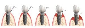 Schritte von gesund über Mucositis zur Periimplantitis und Implantatverlust