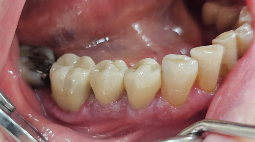 Klinisches Bild einer nekrotisierenden ulzerierenden Gingivitis