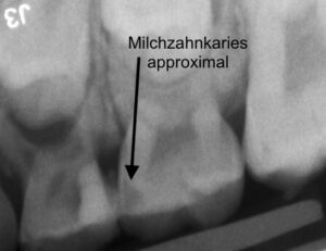 Milchzahnkaries
