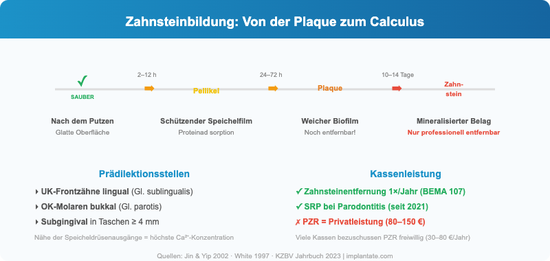Infografik: Zahnsteinbildung in vier Phasen — von der sauberen Oberfläche über Pellikel und Plaque zum mineralisierten Zahnstein