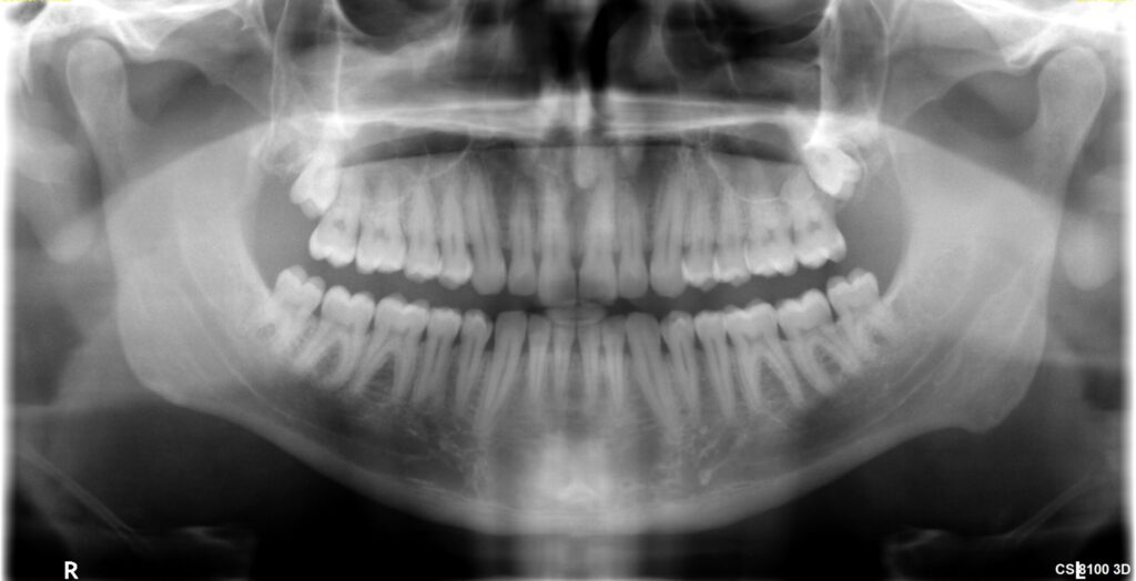 orthograde Weisheitszähne im OPG