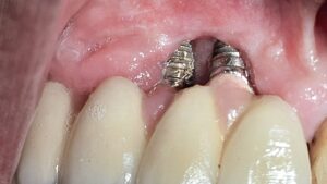 Implantatoberflächen freigelegt und gereinigt Periimplantitistherapie