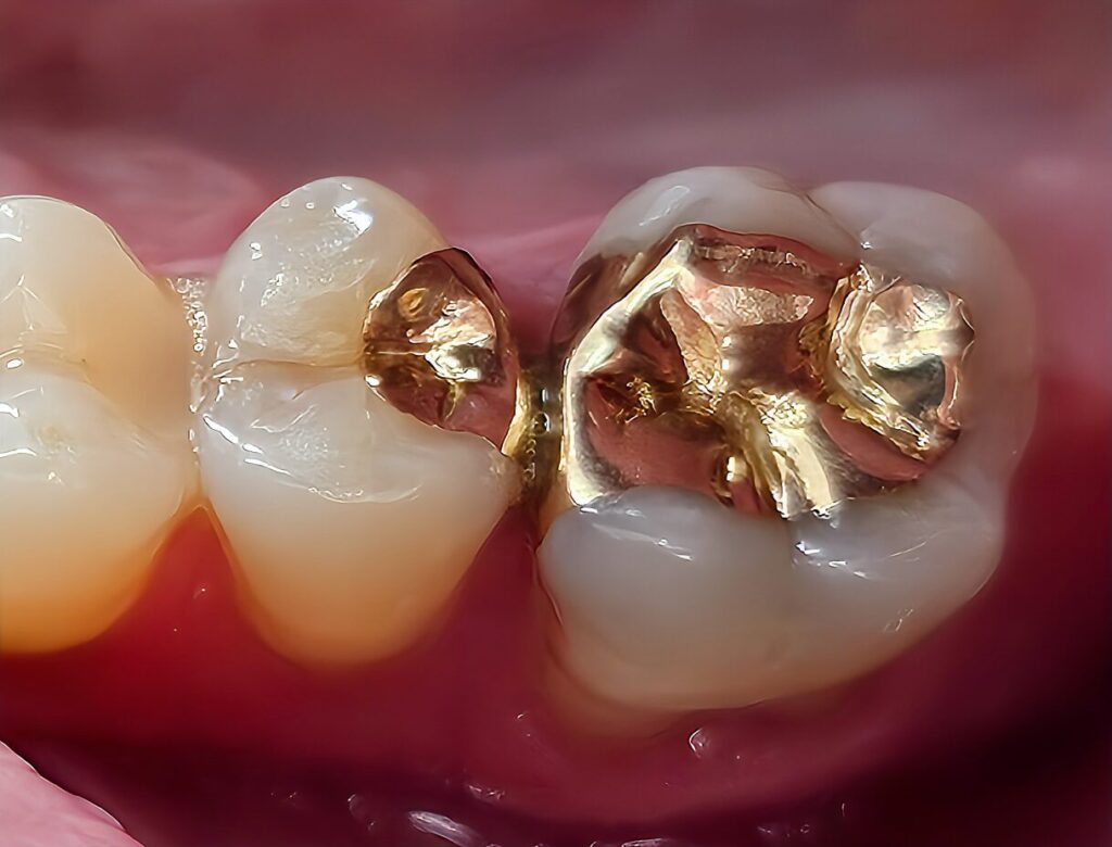 Goldinlays