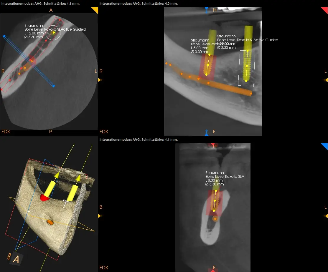3D-Rekonstruktion des Unterkiefers mit Verlauf des Nervus alveolaris inferior und geplanten Implantaten