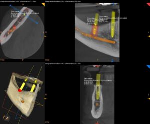 Planung von Implantaten im Unterkiefer: Nervverlauf beachten