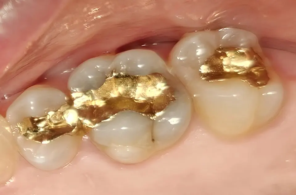 Goldinlays im Seitenzahnbereich an Prämolar und Molar