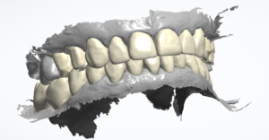 3D-Scan beider Kiefer in Okklusion mit farblich abgesetztem CAD-Entwurf mehrerer Kronen im Oberkiefer