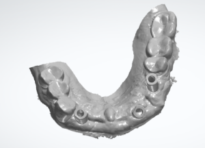 Monochromer Intraoralscan eines teilbezahnten Unterkiefers von okklusal; an drei Implantatpositionen sind Scankörper (Scanbodys) eingeschraubt