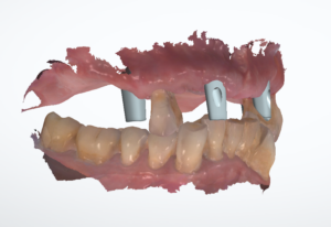 Farbiger Intraoralscan von Ober- und Unterkiefer in Okklusion, im Oberkiefer Scanbodies auf den Implantaten, Seitenansicht