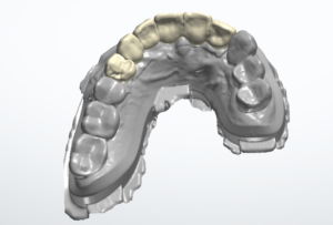 3D-Scan eines Kiefermodells von okklusal mit sechs farblich abgesetzten, digital konstruierten Kronen im Frontzahnbereich
