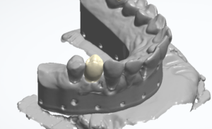 3D-Scan zweier Kiefermodelle in Okklusion mit einer farblich abgesetzten, digital konstruierten Krone auf einem beschliffenen Zahn