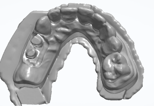 3D-Scan eines Kiefermodells von okklusal mit aufgesetzter Gingivamaske und freiliegenden Implantatpositionen im Seitenzahnbereich