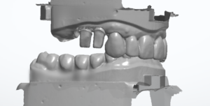 3D-Scan zweier Kiefermodelle in Okklusion aus seitlicher Perspektive mit beschliffenen Frontzahnstümpfen im Oberkiefer