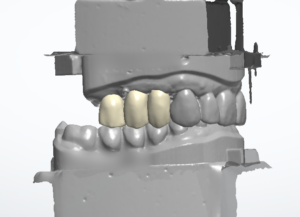 3D-Scan zweier Kiefermodelle in Okklusion mit drei farblich abgesetzten, digital konstruierten Kronen im Frontzahnbereich