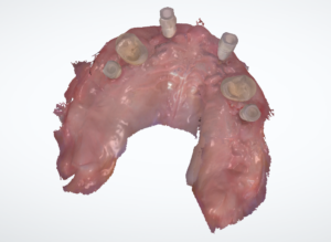 Farbiger 3D-Scan des Oberkiefers von okklusal mit Scanbodies und Implantataufbauten im zahnlosen Kieferabschnitt