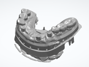 3D-Scan eines Sägemodells auf Pin-Sockel von schräg okklusal mit mehreren Implantatpositionen und verbliebenen Seitenzähnen